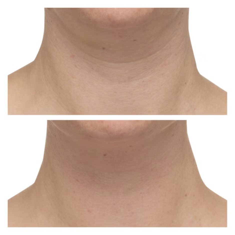 StriVectin Neck Cream Plus before and after on neck